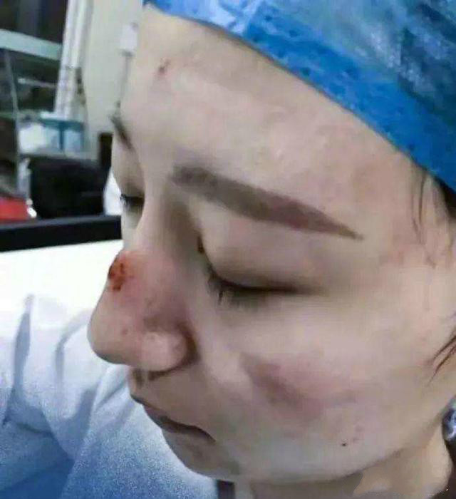 口罩压疮难解决 俪龄之密来帮忙